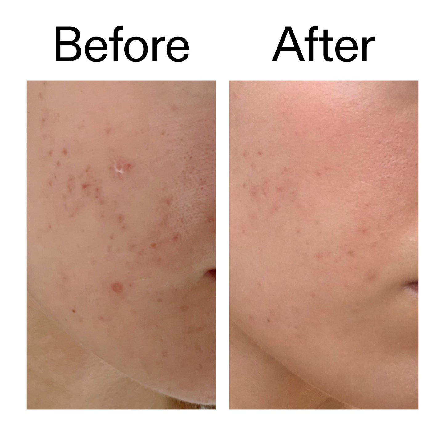mandelic-acid-treatment-t5 Mandelic_Acid_Treatment_Before_After_2000x2000_4885ac6e-c5d7-4279-a72a-1417af7dce35.jpg
