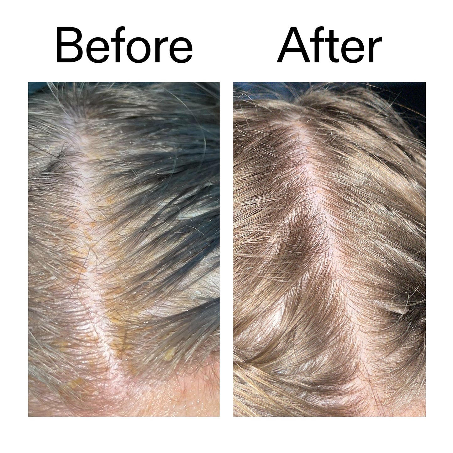 salicylic-acid-exfoliating-scalp-treatment-g9 Salicylic_Acid_Exfoliating_Scalp_Treatment_Before_After_2000x2000_e572a30f-057c-4a48-823b-1c09dc97f8d0.jpg