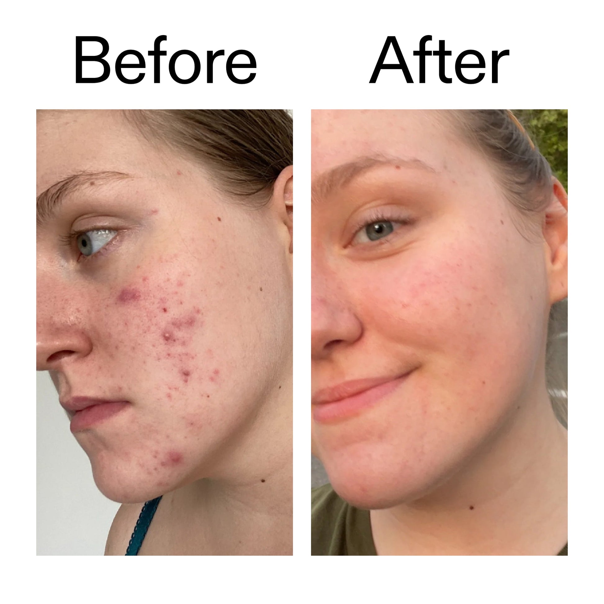 15-vitamin-c-egf-serum-z6 15_Vitamin_C_EGF_Serum_Before_After_2000x2000_fb9f598a-3386-40c8-8143-36f9d7a17ec8.jpg