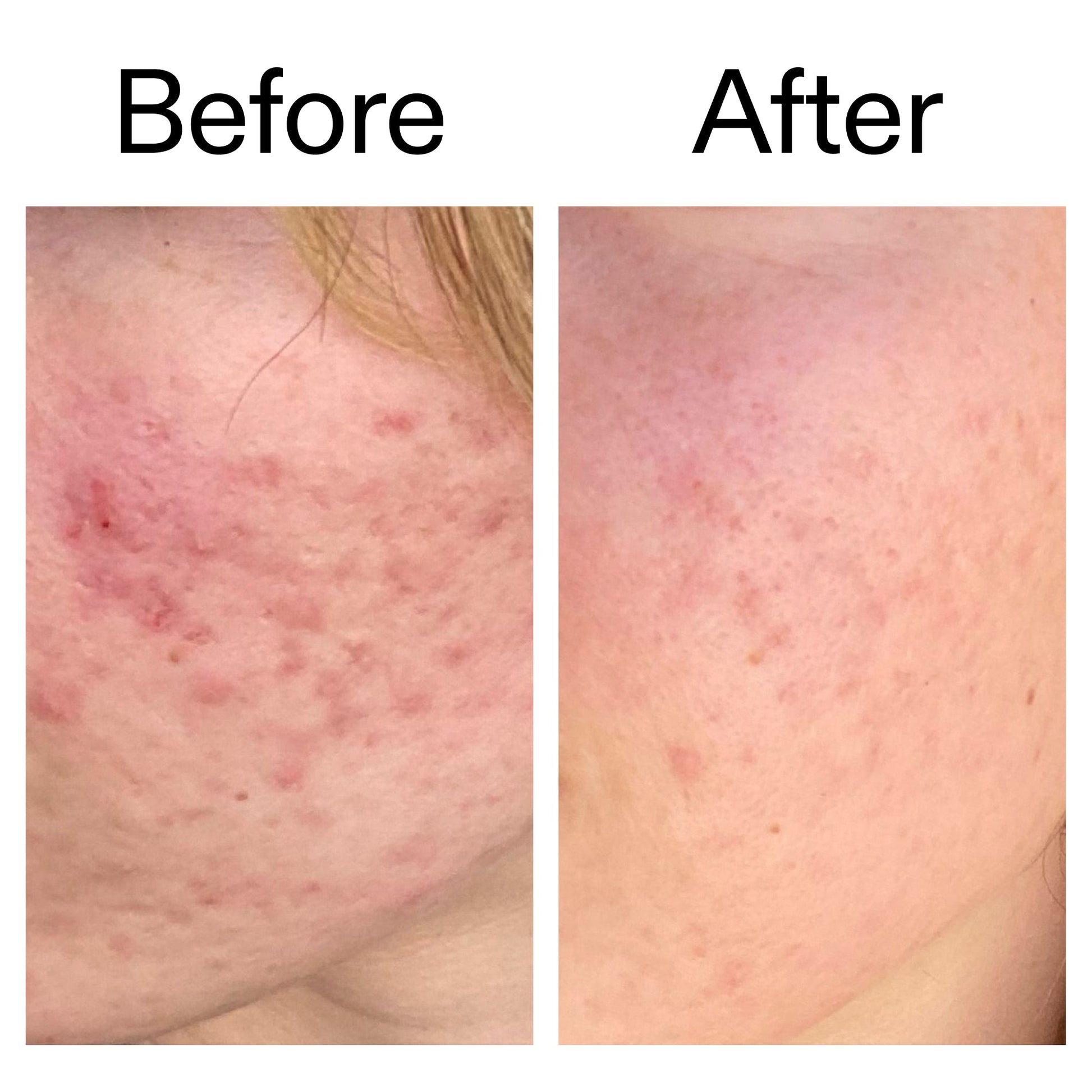 10-azelaic-acid-serum-for-redness-relief-u1 Azealic_Acid_Serum_B_A_Ppage_2000_x_2000.jpg
