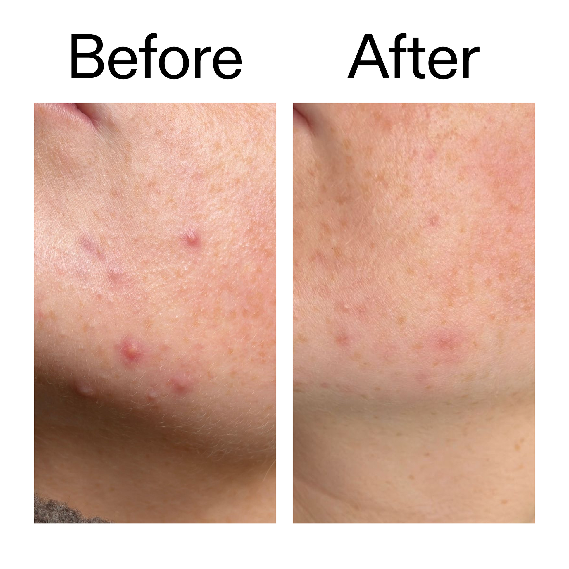 10-azelaic-acid-serum-for-redness-relief-u1 B_A_1_PPAGE.png