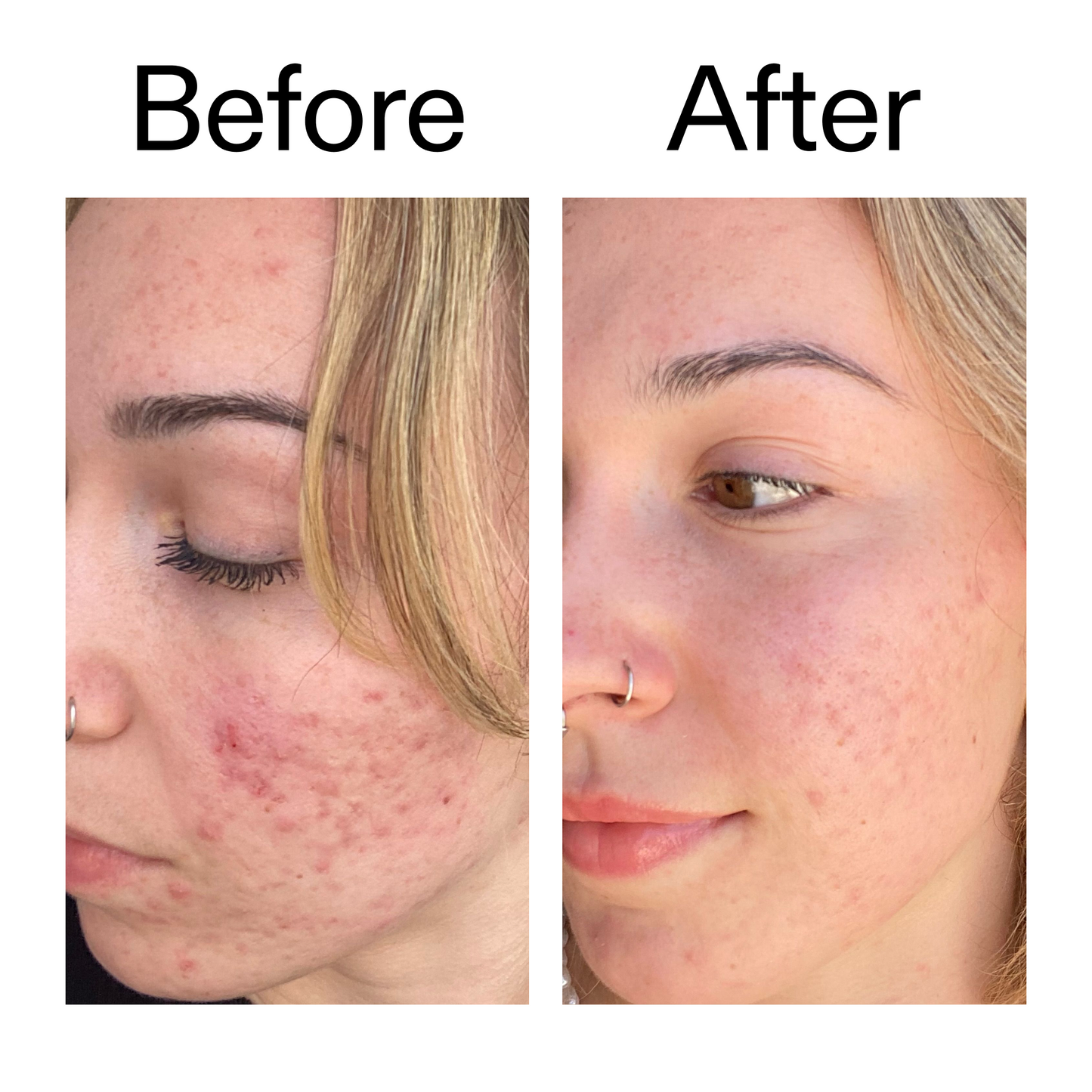 10-azelaic-acid-serum-for-redness-relief-u1 B_A_2_PPAGE.png