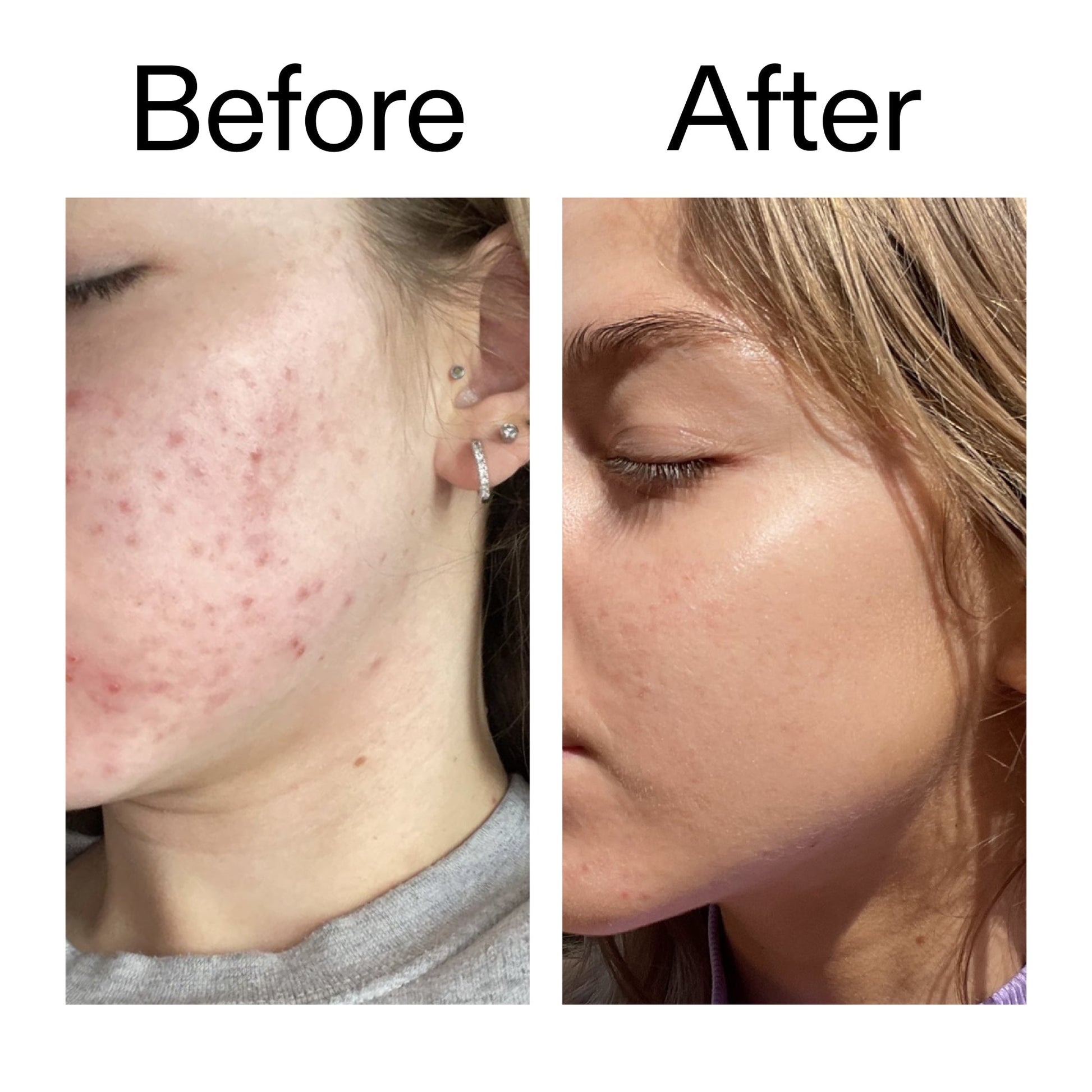 beta-hydroxy-acid-bha-serum-n2 Beta_Hydroxy_Acid_Serum_Before_After_2000x2000_96fda3e5-938d-49ef-bcf2-a0fa6ece4e2c.jpg