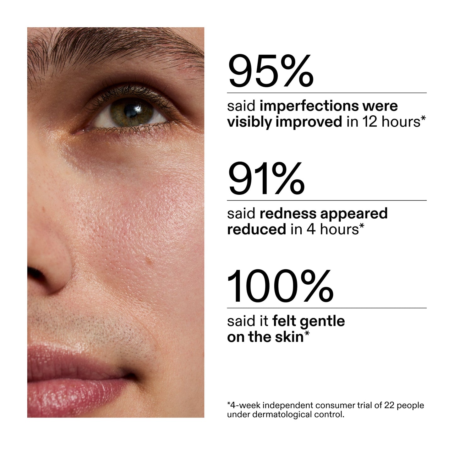 succinic-acid-acne-treatment-t6 CA_Succinic_Acid_Treatment_key_Claims_2000x2000_db91b0f1-7f29-4bfe-bb16-63a47f500960.jpg