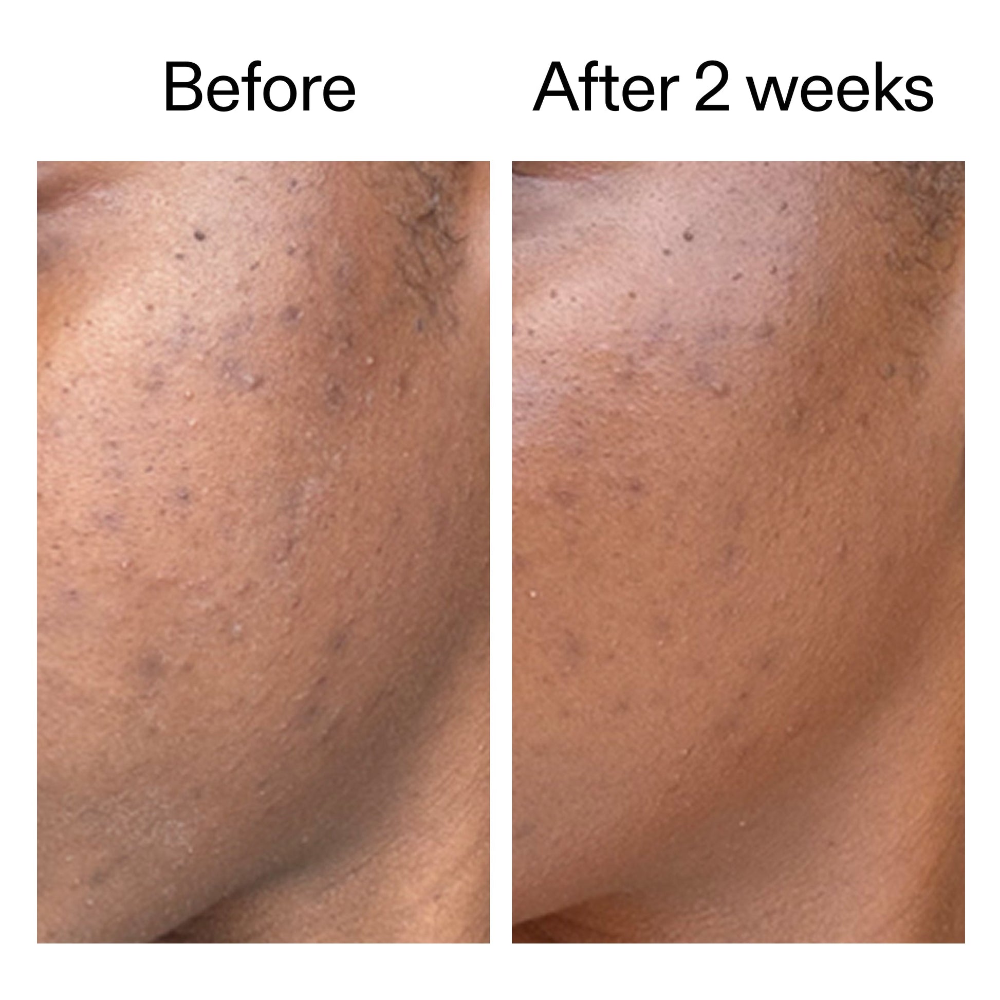 360-acne-clearing-duo-h7 DIOICB_A2000x2000.jpg