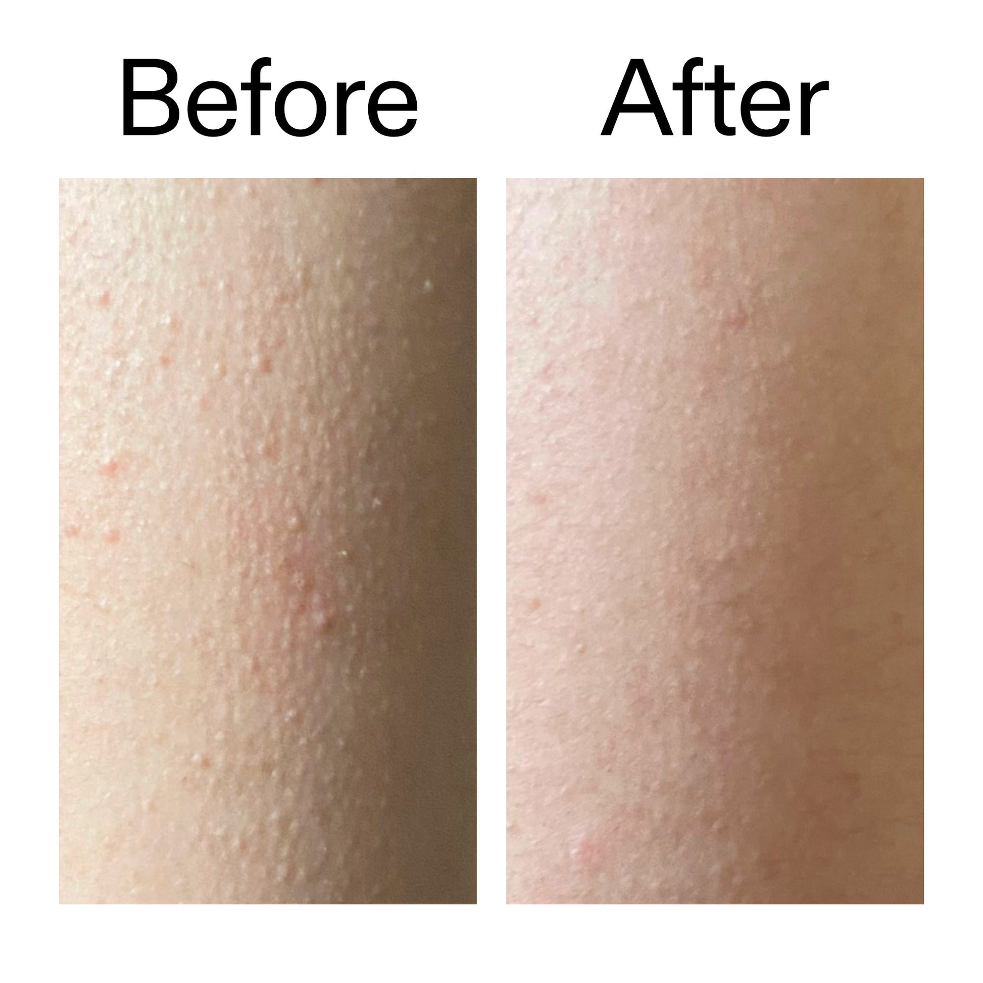 glycolic-acid-exfoliating-body-stick-duo-z2 Glycolic_Acid_Exfoliating_Body_Stick_Before_After_V2_2000x2000_2e4ba052-94f6-4d56-82df-7bdb5b2df7ae.jpg