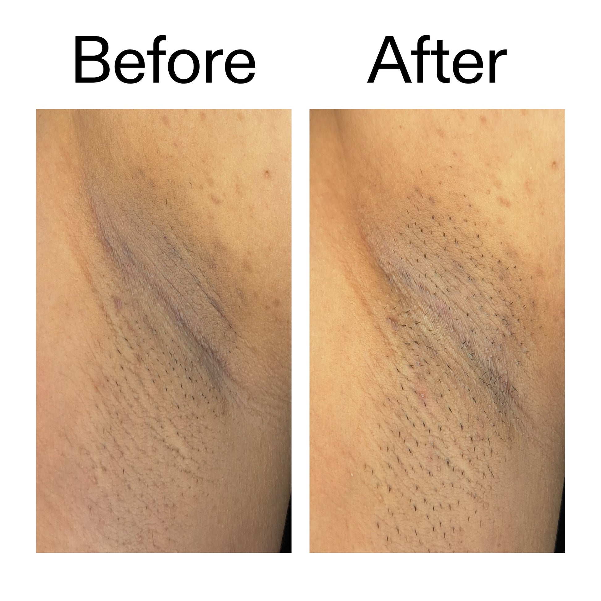 glycolic-acid-exfoliating-body-stick-n7 Glycolic_Acid_Exfoliating_Body_Stick_Before_After_V3_2000x2000_ea919cd9-1439-4a46-82a0-76200eb5bb42.jpg
