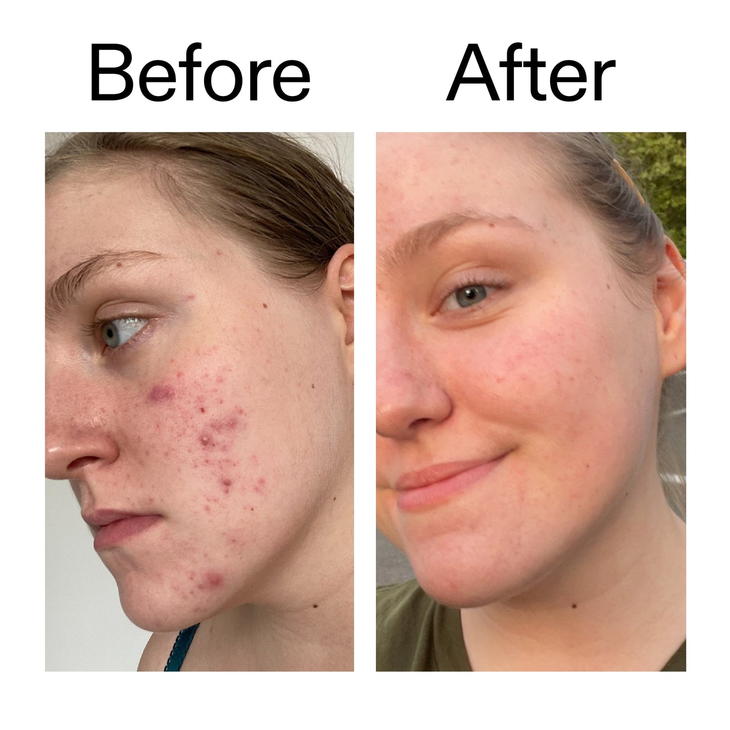 glycolic-acid-toner-e8 Glycolic_Acid_Toner_Before_After_2000x2000_49f0b9f7-e71b-4b2e-a8f8-2ea4b73247bb.jpg