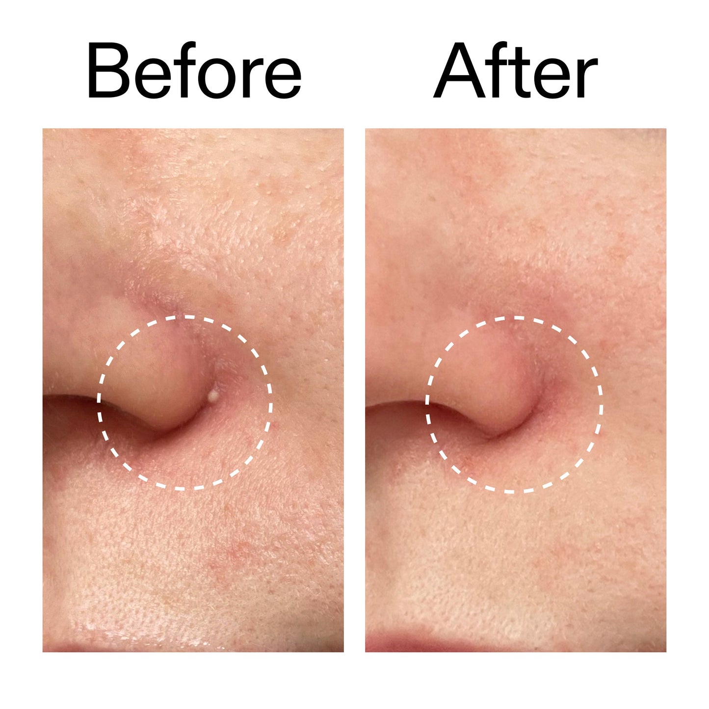 hydrocolloid-invisible-pimple-patches-pack-of-22-z5 Hydrocolloid_Invisible_Pimple_Patches_Before_After_2000x2000_b02aa37b-c78a-4682-91de-9135af5bb7df.jpg