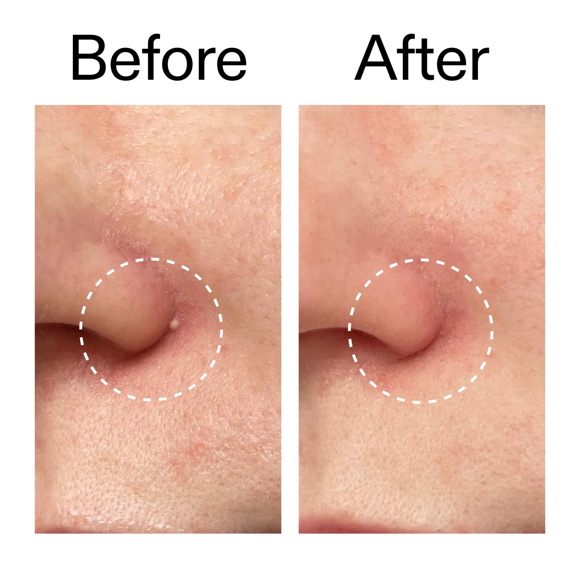 hydrocolloid-invisible-pimple-patches-pack-of-44-x1 Hydrocolloid_Invisible_Pimple_Patches_Before_After_2000x2000_b02aa37b-c78a-4682-91de-9135af5bb7df.jpg