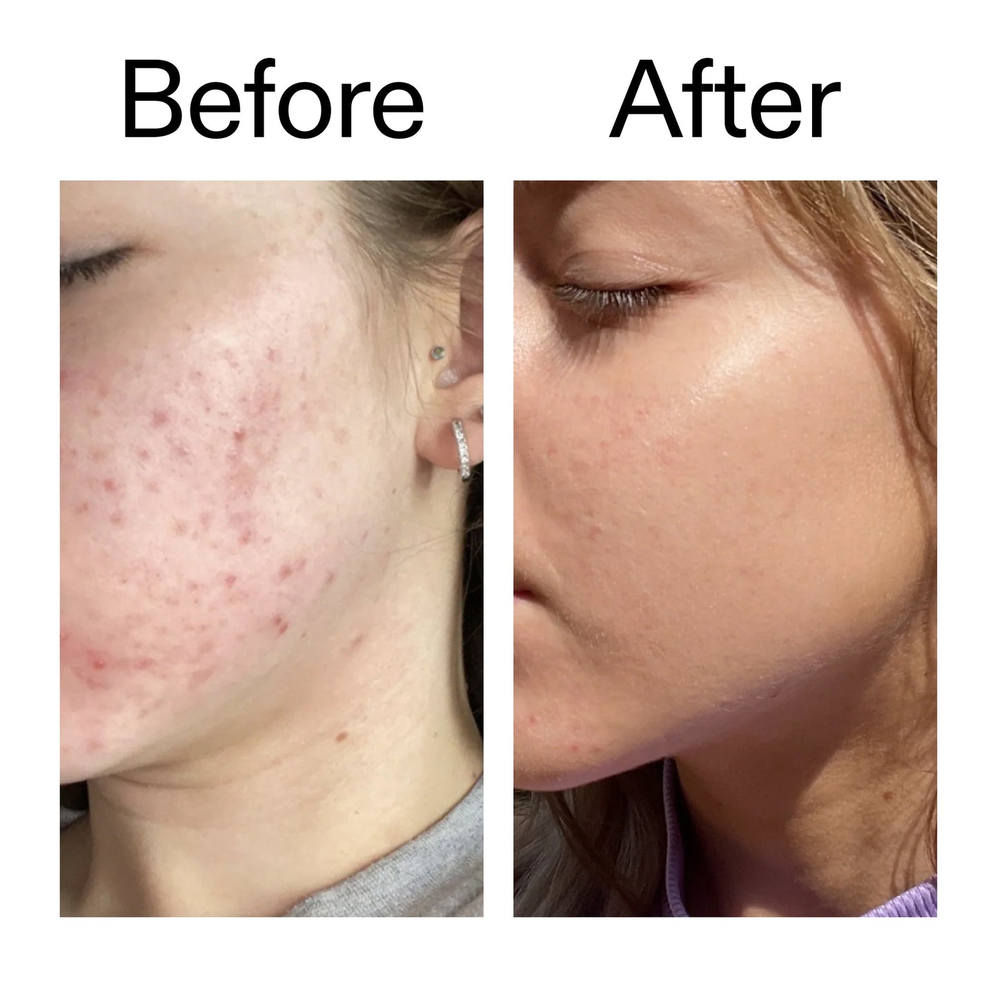 10-niacinamide-serum-duo-e8 Niacinamide_Serum_Before_After_2000x2000_bde32455-9e7d-448e-b053-bef41504f0a9.jpg