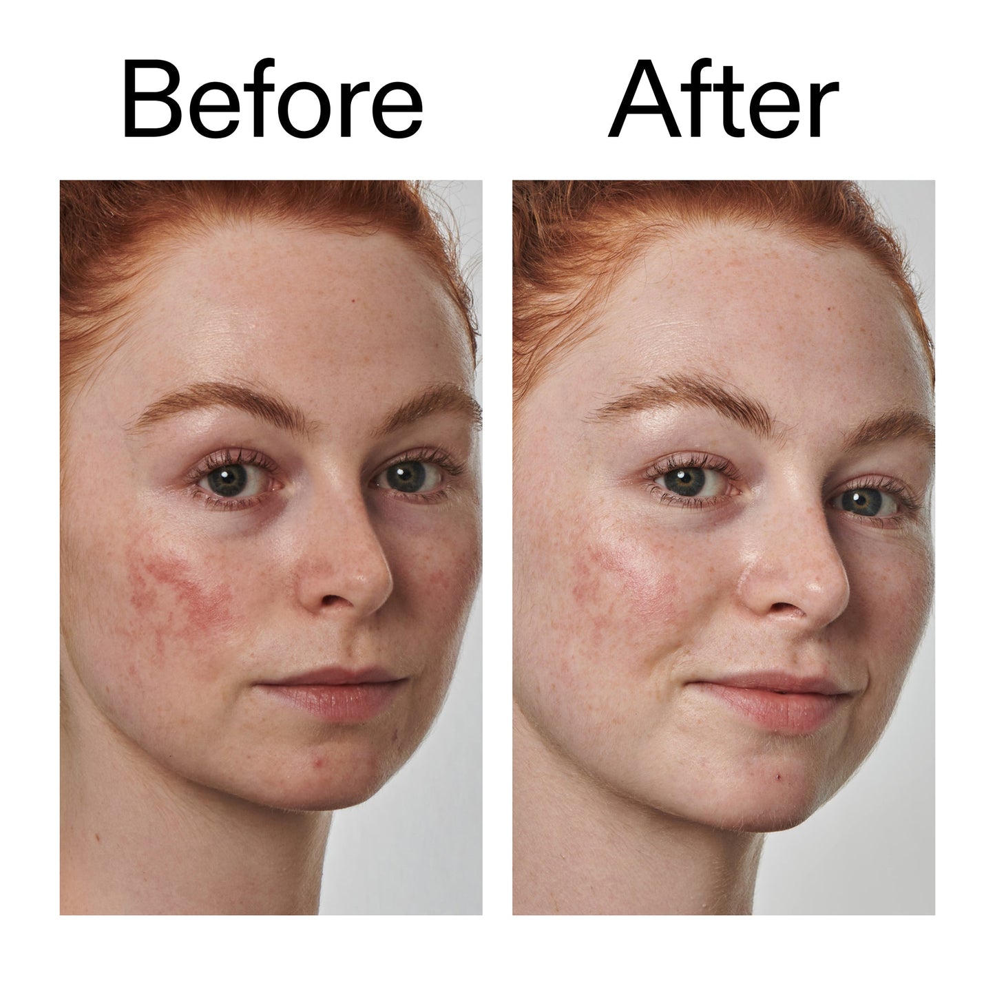 10-azelaic-acid-serum-for-redness-relief-u1 Redness_Relief_Serum_Before_After_2000x2000_3334dc9a-cce9-4e00-8aec-7ad89ca051f2.jpg