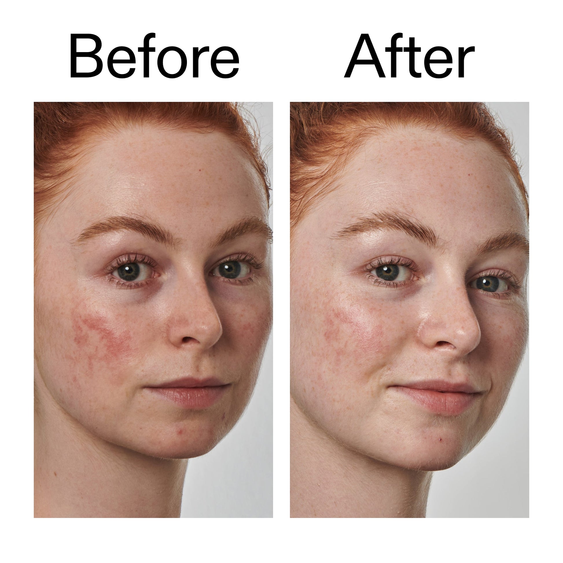 10-azelaic-acid-serum-for-redness-relief-u1 Redness_Relief_Serum_Before_After_2000x2000_3334dc9a-cce9-4e00-8aec-7ad89ca051f2.jpg