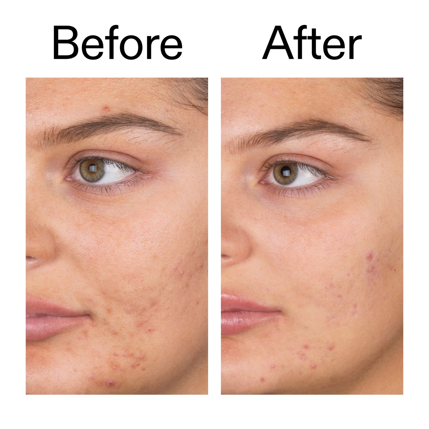 salicylic-acid-cleanser-150ml-r6 Salicylic_Acid_Cleanser_-_150ml_Before_After_2000x2000_e7230494-853f-4b07-82b1-27669104c995.jpg