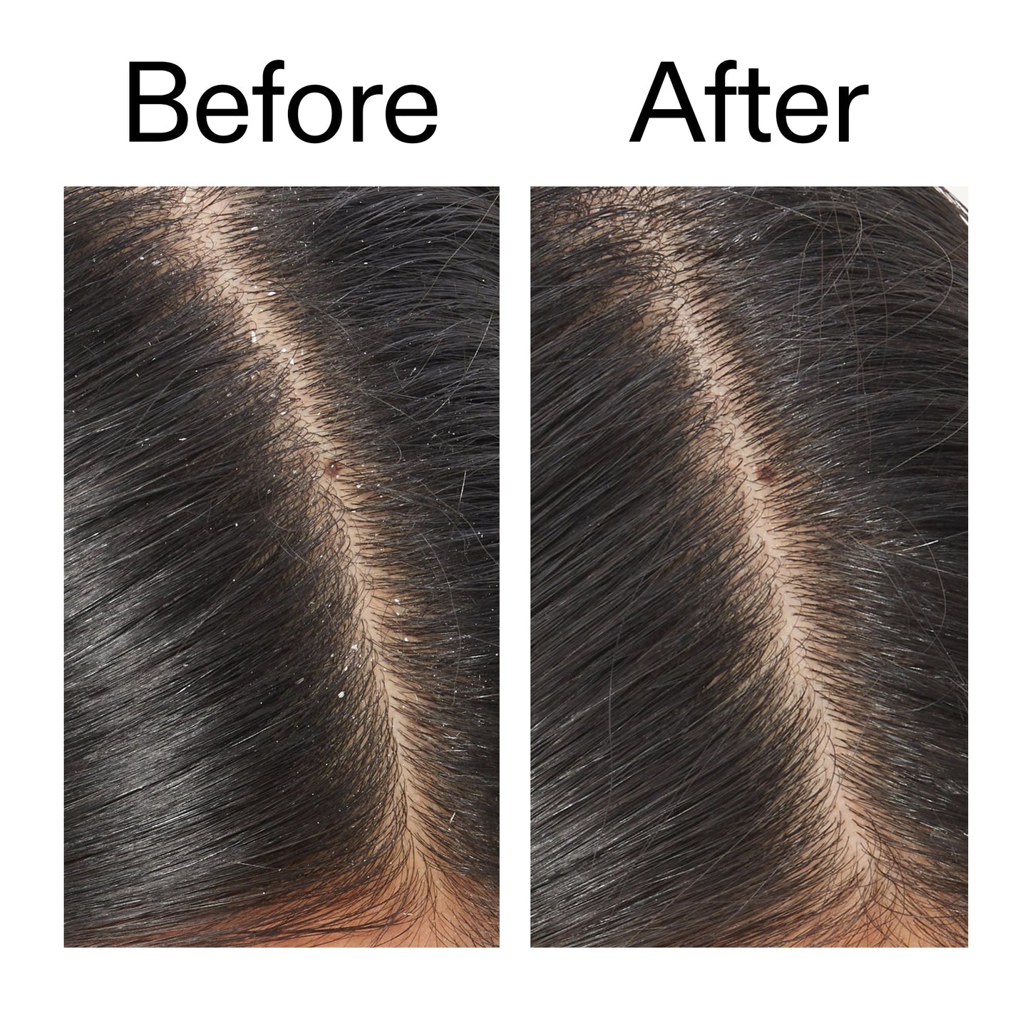 salicylic-acid-exfoliating-scalp-treatment-g9 Salicylic_Acid_Exfoliating_Scalp_Treatment_Before_After_V2_2000x2000_02bd61ad-42bf-490b-b3e3-7e04b2e8a673.jpg