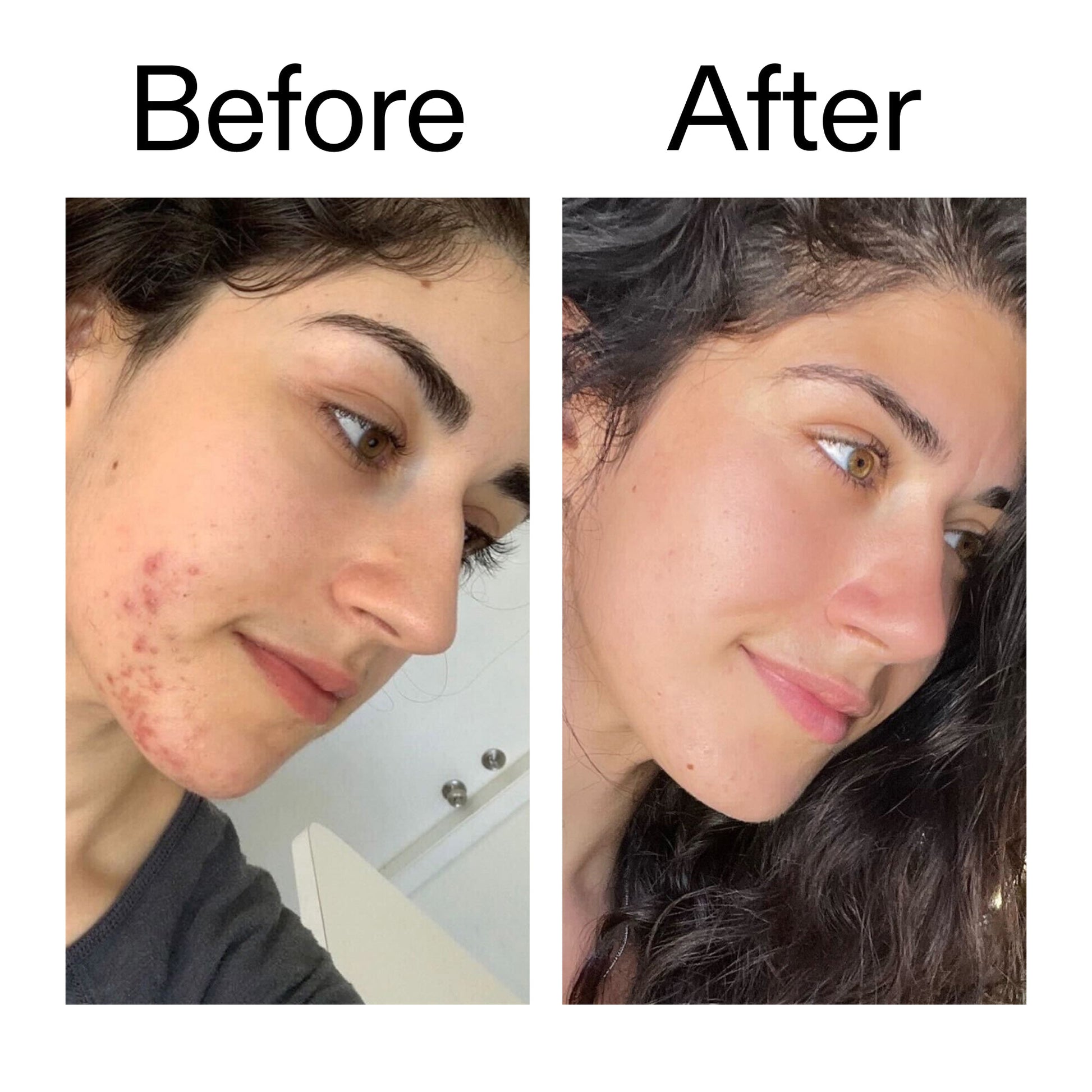 succinic-acid-acne-treatment-t6 Succinic_Acid_Treatment_Before_After_2000x2000_6a5f0054-2f58-4433-9314-0dc72c9bdd3b.jpg