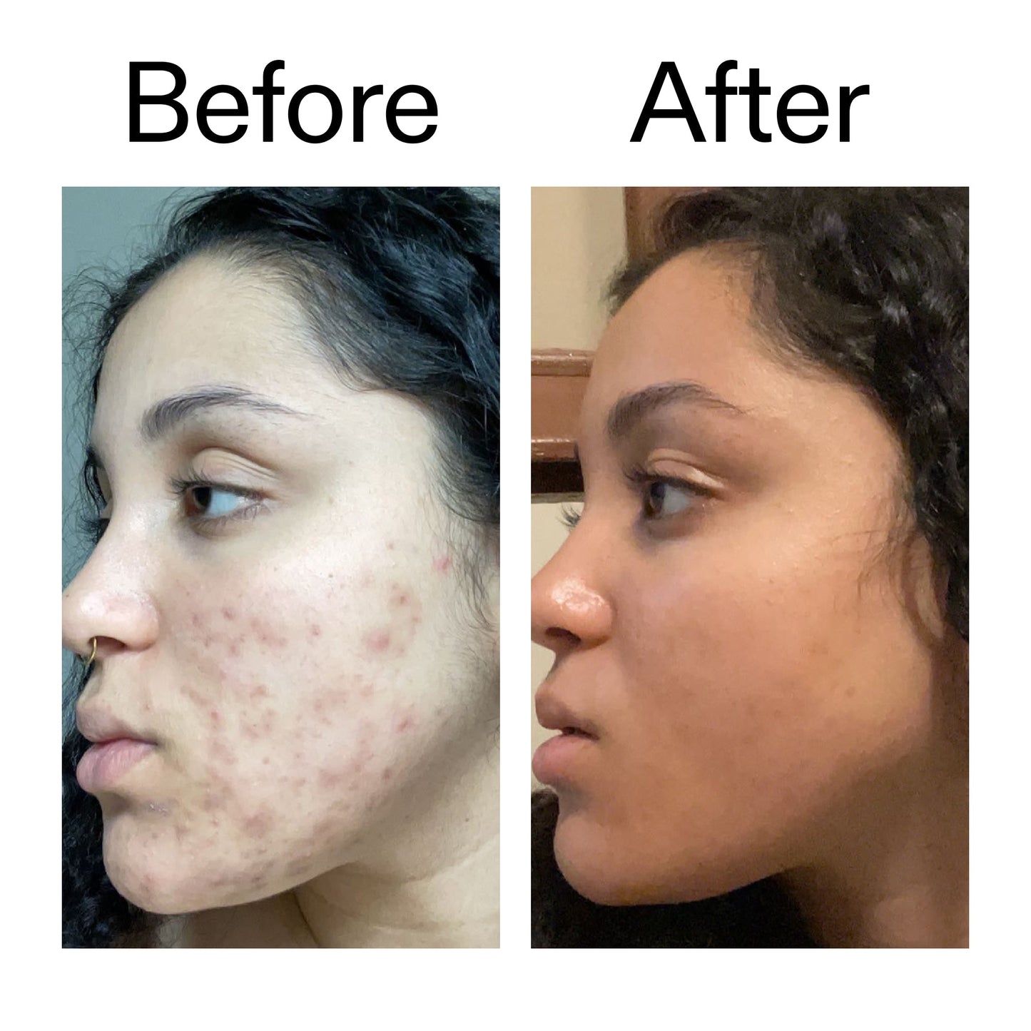 tranexamic-acid-serum-j4 Tranexamic_Acid_Serum_Before_After_2000x2000_98ebc8be-77b0-4843-8a22-90790ebe918b.jpg
